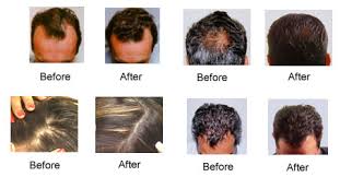 Hair Replacement center Dallas, hair loss treatments Dallas, hair loss treatment Fort Worth, cancer wigs Fort Worth, cancer wigs Plano 
