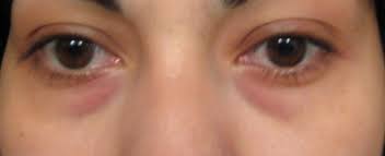 نصائح لإخفاء الهالات السوداء حول العين..... Images?q=tbn:ANd9GcR52A6V1ZN7awTLXNX_7xDuc7Xg05GHGsv9UDC7N17u5IaMBSUL