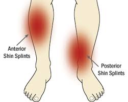 Anterior Shin Spints vs. Posterior Shin Splints