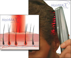 hair max laser comb, hair loss clinic, cancer wigs male pattern baldness, hair loss doctor, Womens hair loss, treatment for hair thinning, best hair replacement, Hair loss Plano 