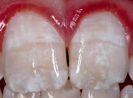 Fluoride Damage on Teeth Vital Force Clinic St Loui