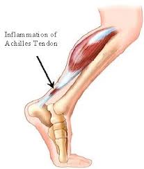 Inflamed Achilles Tendon